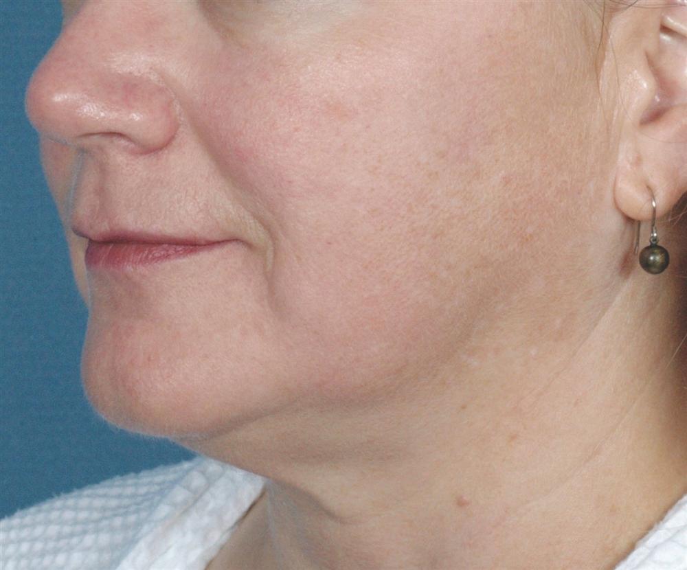 Skin Tightening Post Treatment